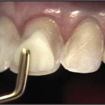 Applying bonding agent to tooth