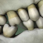 Opposing Teeth Extrude