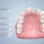Aesthetic Tooth Alignment
