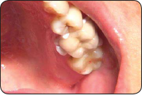 Bonding porcelain crown to prepared tooth